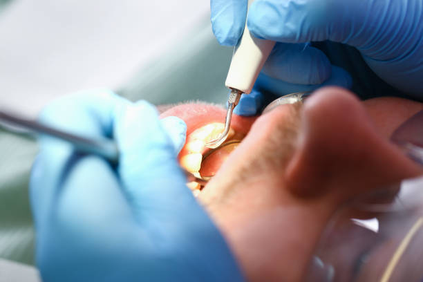 Best Emergency Dental Care for Broken or Chipped Teeth in Hurricane, UT